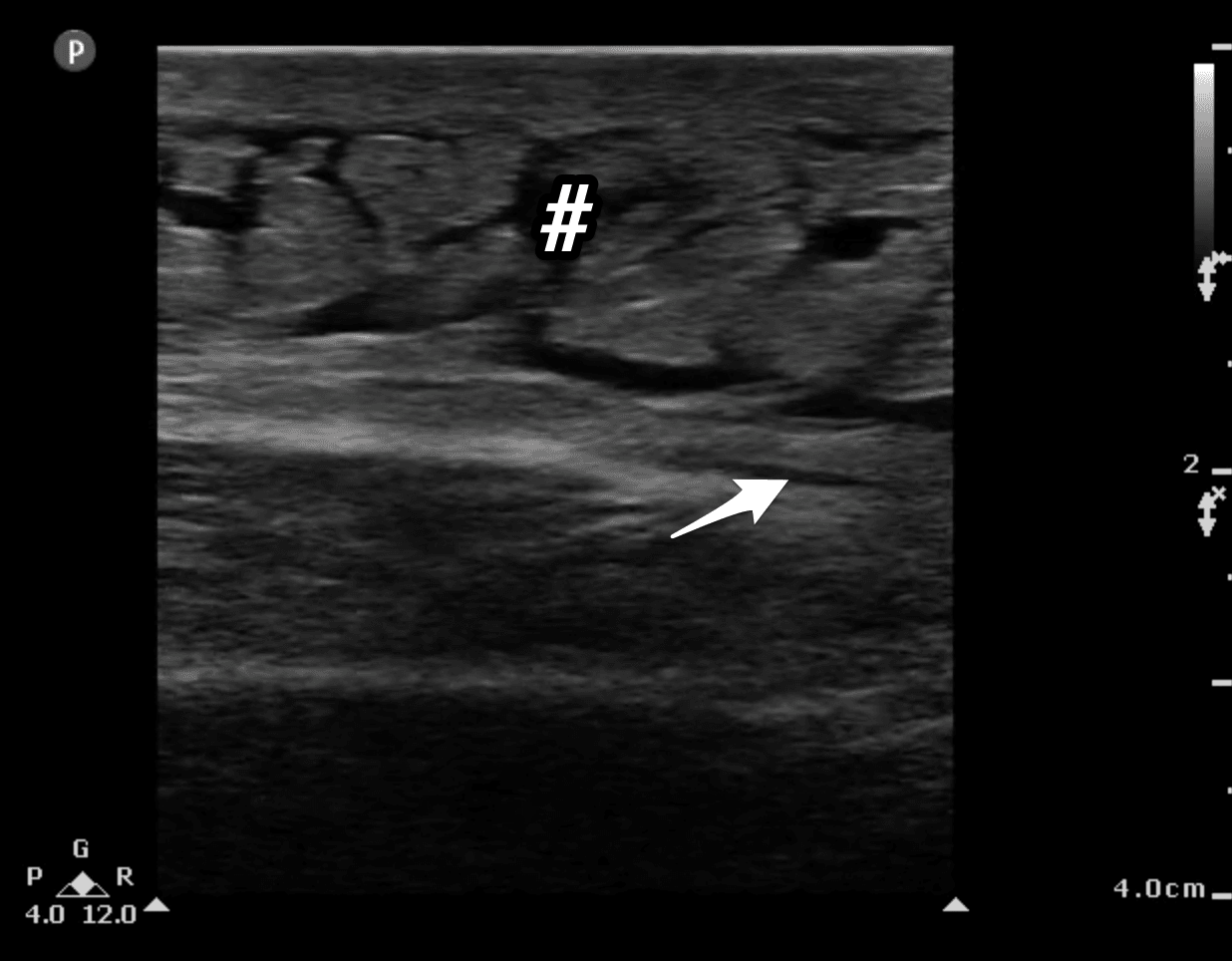Ultrasound For The Win 63M With An Erythematous Abdomen US4TW ultrasound-for-the-win-63m-with-an-erythematous-abdomen-us4tw